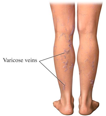 Image showing varicose veins