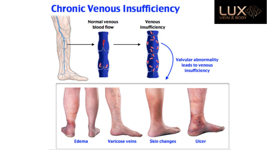 Chronic Venous Insufficiency diagram showing normal venous blood flow vs venous insufficiency, including valve dysfunction and symptoms such as edema, varicose veins, skin changes, and leg ulcers.